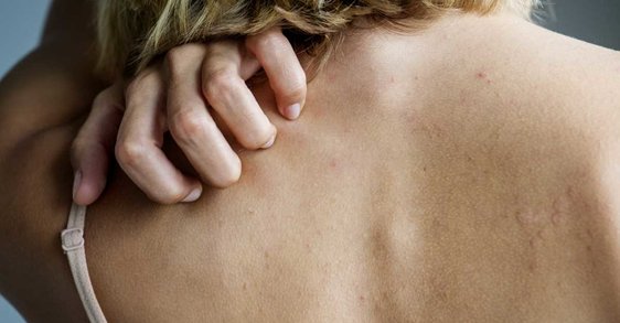 Защо е обичайно да имаме повече кожни алергии по време на менопаузата и как да ги облекчим?